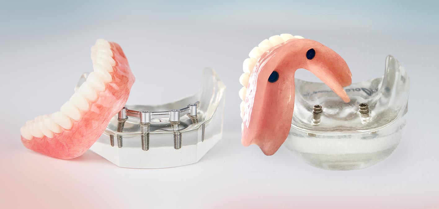 Traditional dentures compared with implant supported dentures in Guildford