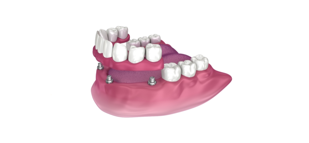 Replacing a Row of Missing Teeth Using Fixed Implant-Supported Bridges