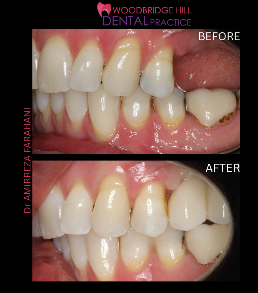 Dental implant before and after result, Guildford patient case 16