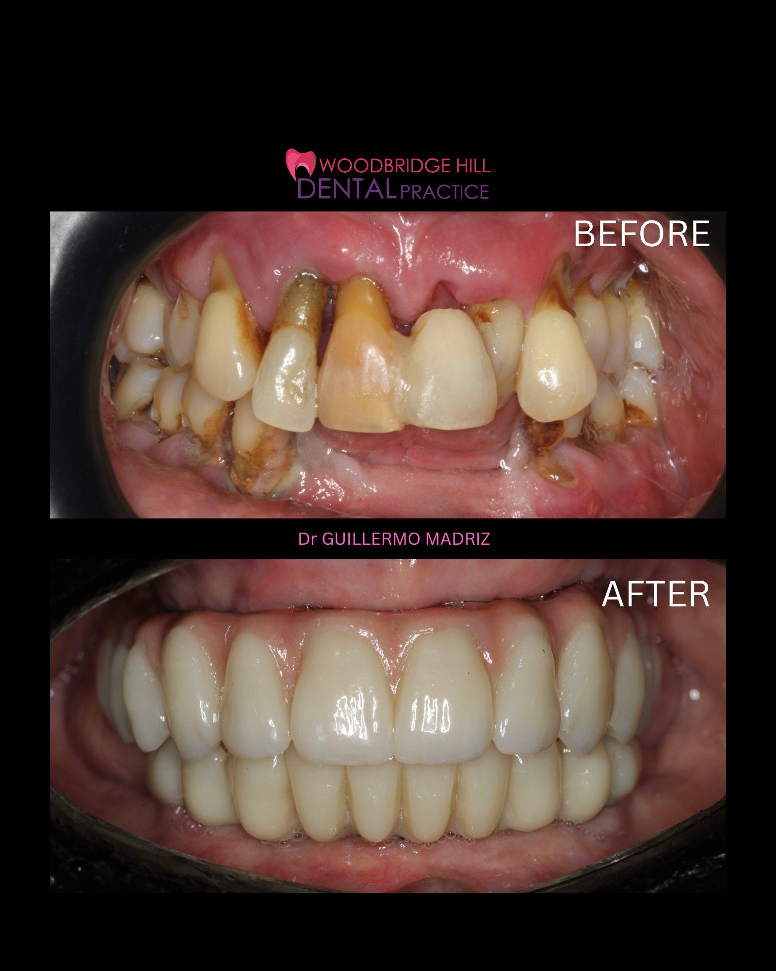 Full-mouth dental implant patient case in Guildford – case image 2
