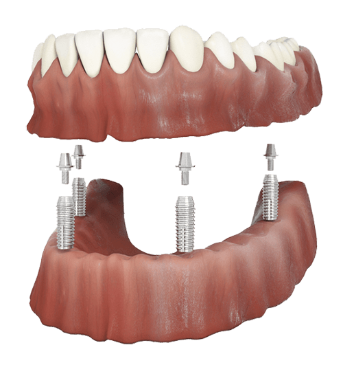 Implant retained denture on dental implants