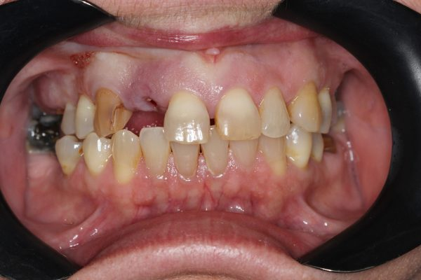 Missing upper tooth before dental implant treatment in Guildford