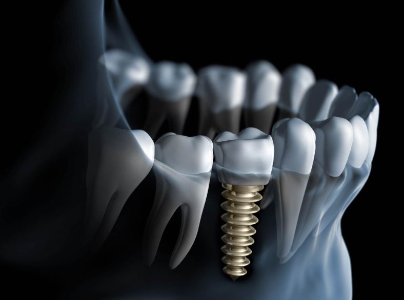 How a dental implant replaces a missing tooth – Guildford implant dentist