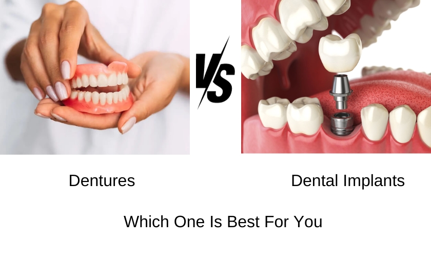 Dental Implants vs. Dentures: Which One is the Better Option?