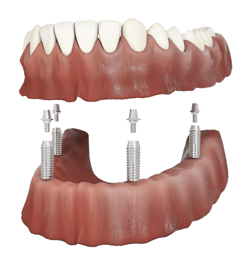 All-on-4 dental implants supporting a full arch of replacement teeth