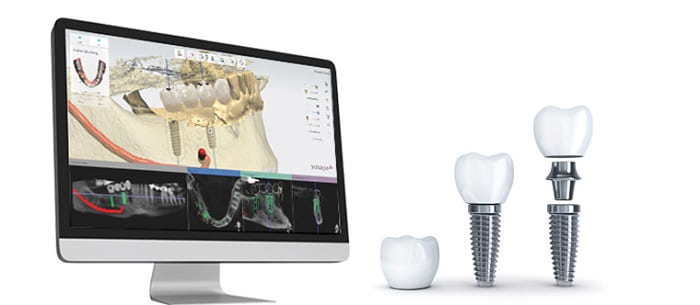 dental implants guildford