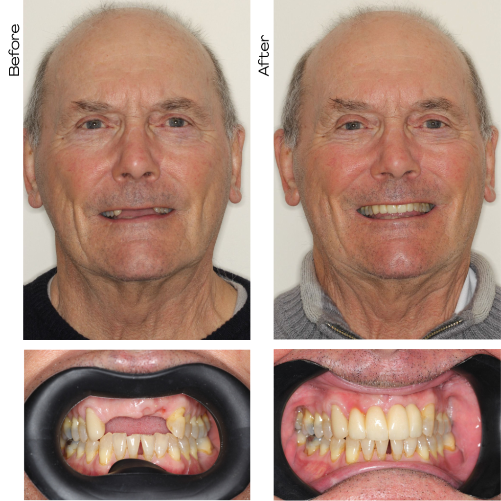 Dental implant before and after result, Guildford patient case 19