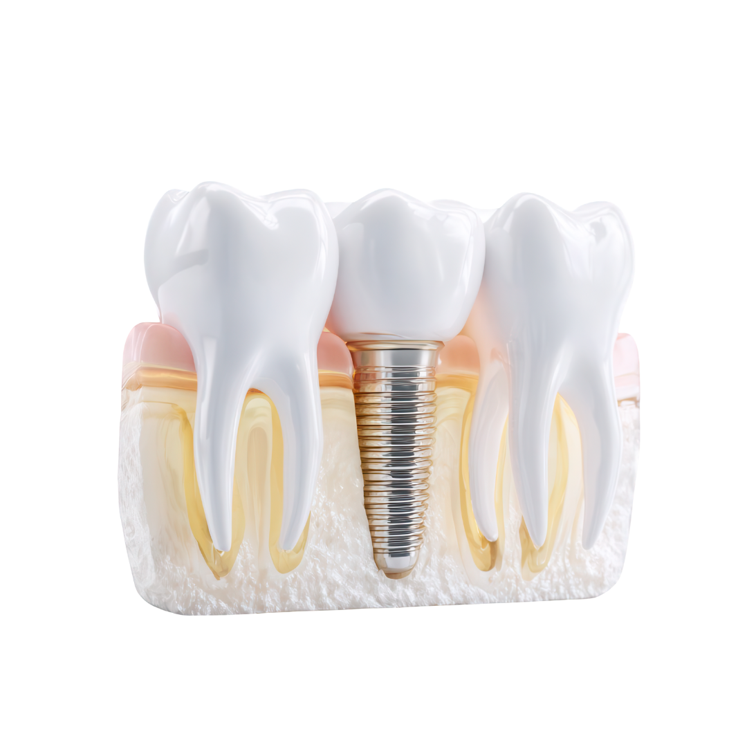Single dental implant model showing the implant post and crown