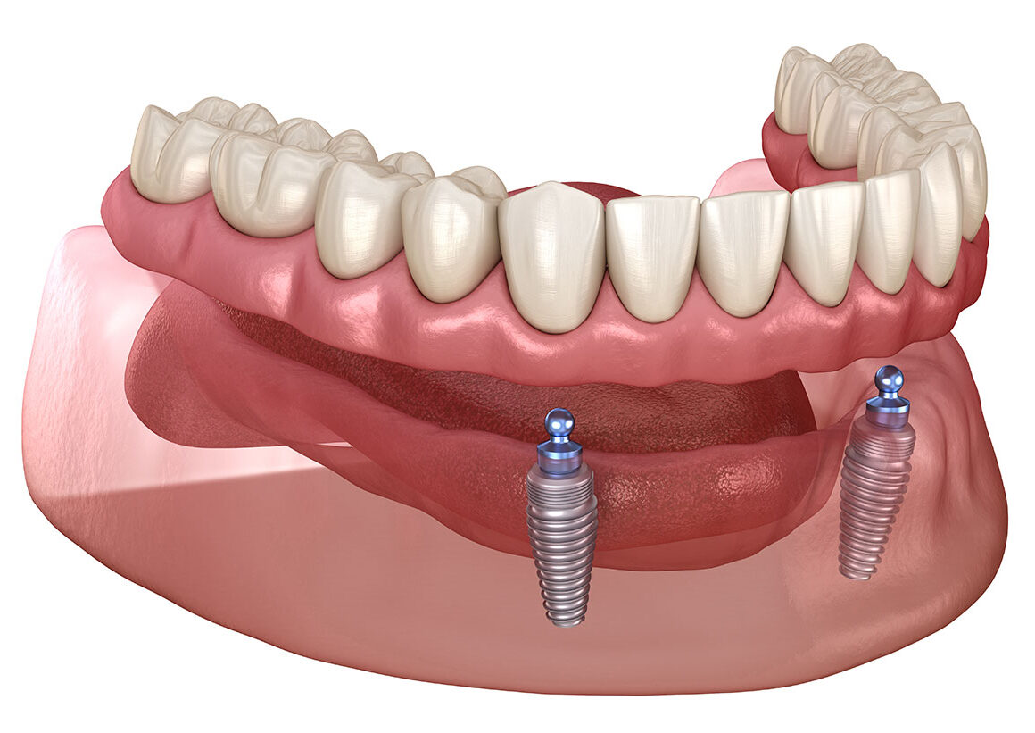 Implant supported denture clipping onto dental implants – Guildford
