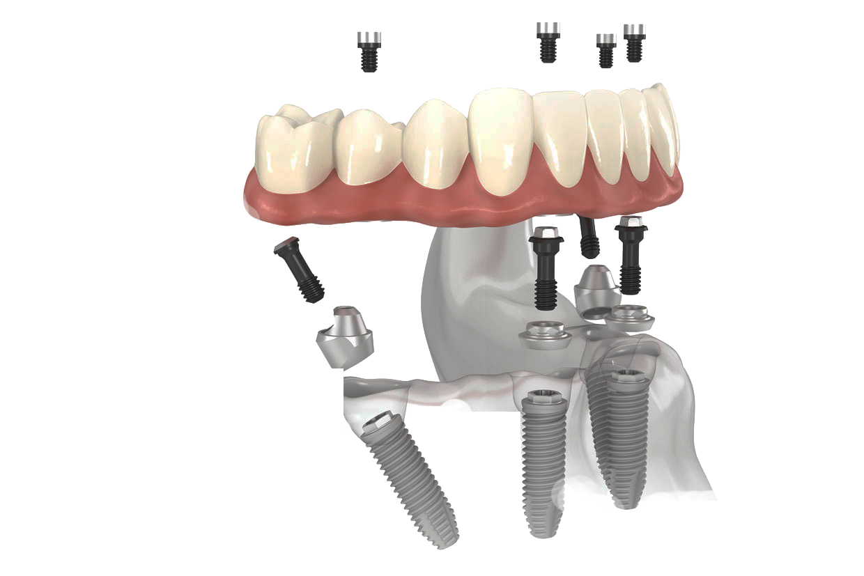 All-on-4 dental implants supporting a full arch of teeth