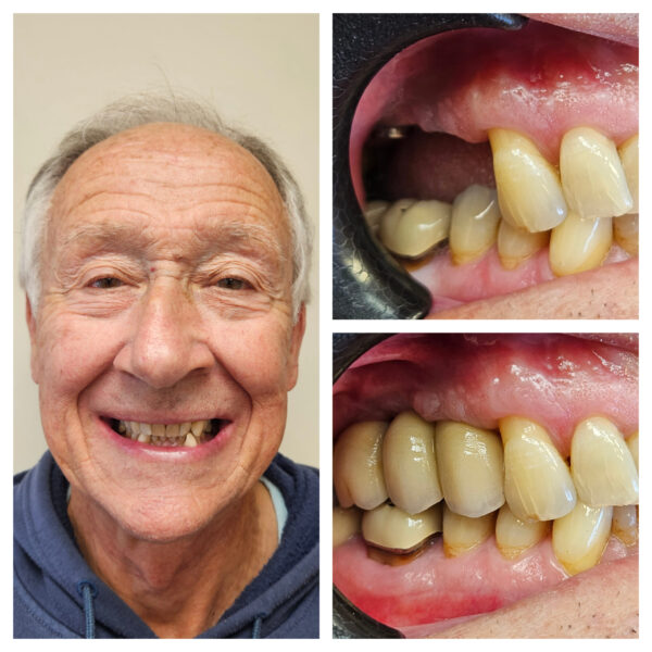 Dental implant before and after result, Guildford patient case 20