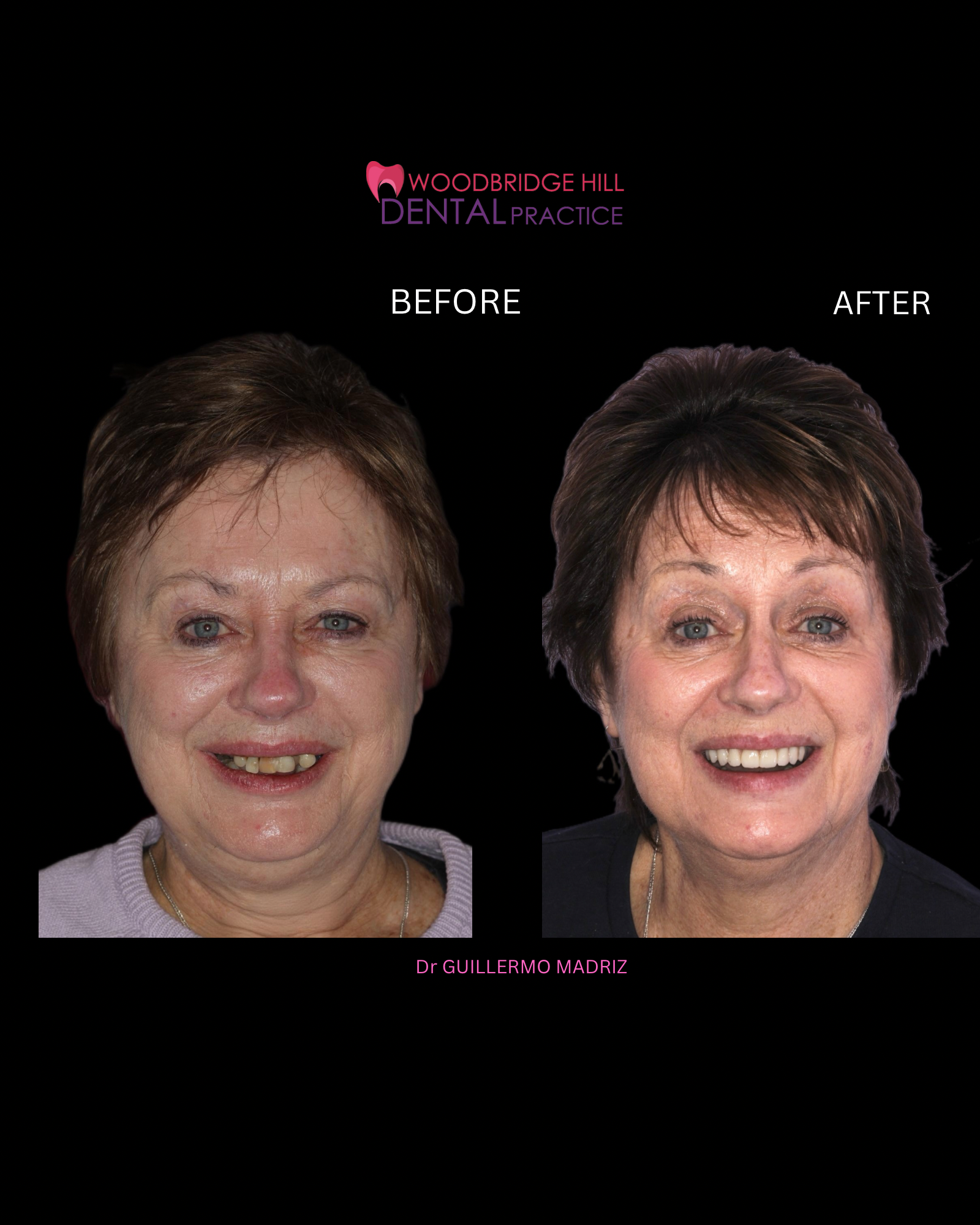 Full-mouth dental implant patient case in Guildford – case image 1