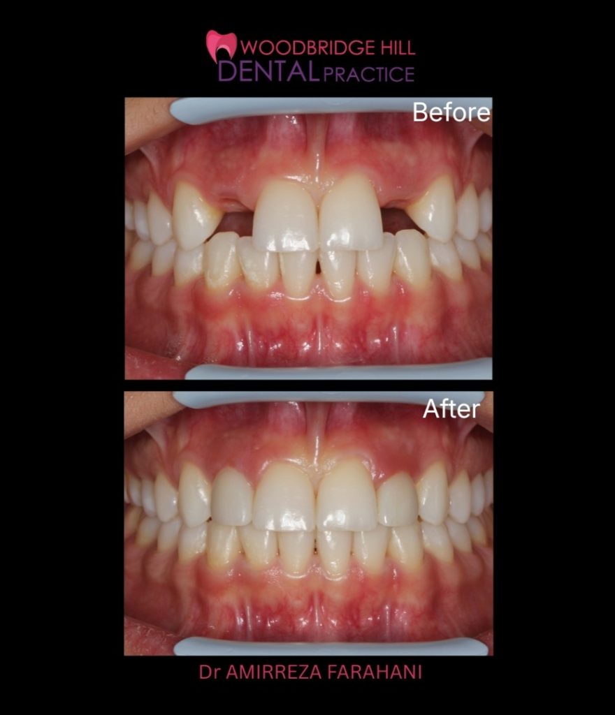 Dental implant before and after result, Guildford patient case 17