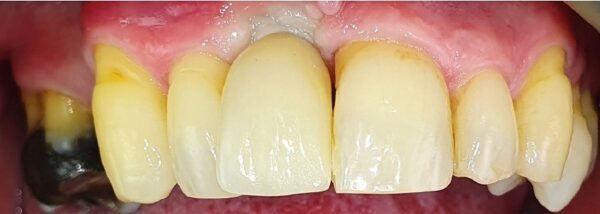 Front tooth restored with an implant crown in Guildford