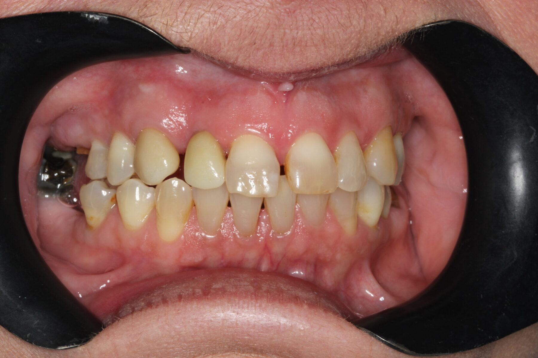 Dental implant before and after result, Guildford patient case 14