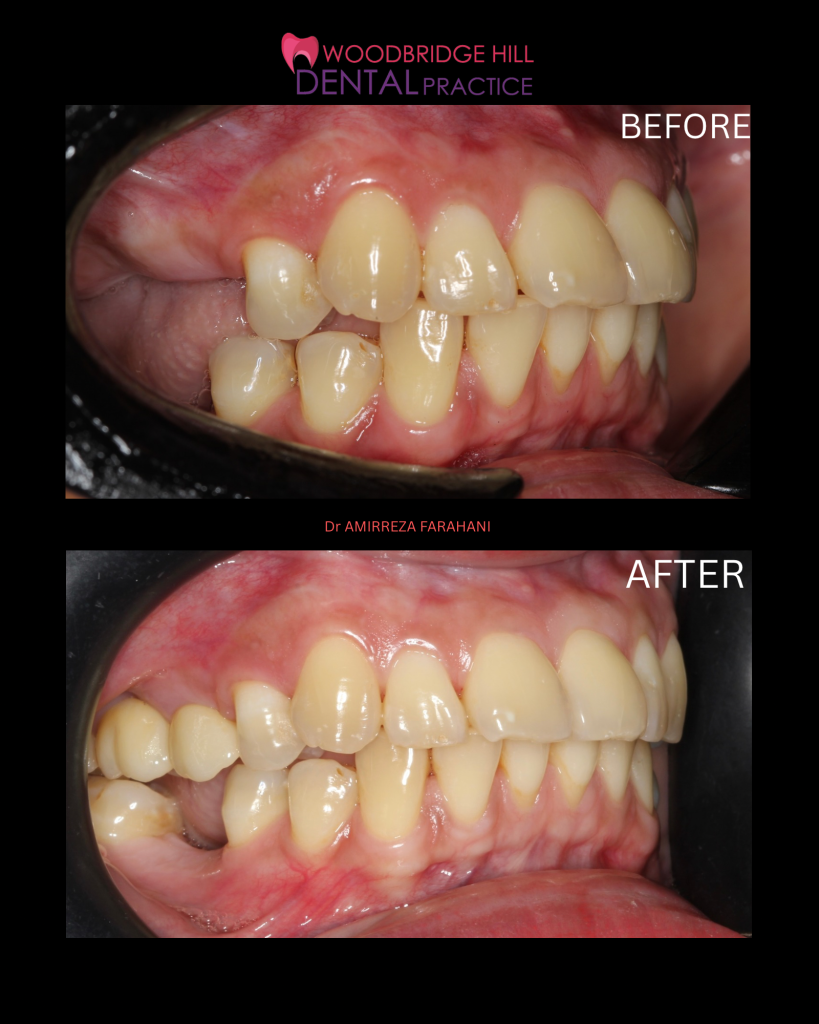 Dental implant result — side view before and after