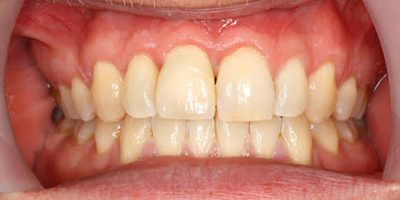 Front tooth restored with a dental implant in Guildford
