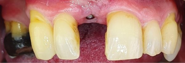 Implant placed for a missing front tooth before the crown in Guildford
