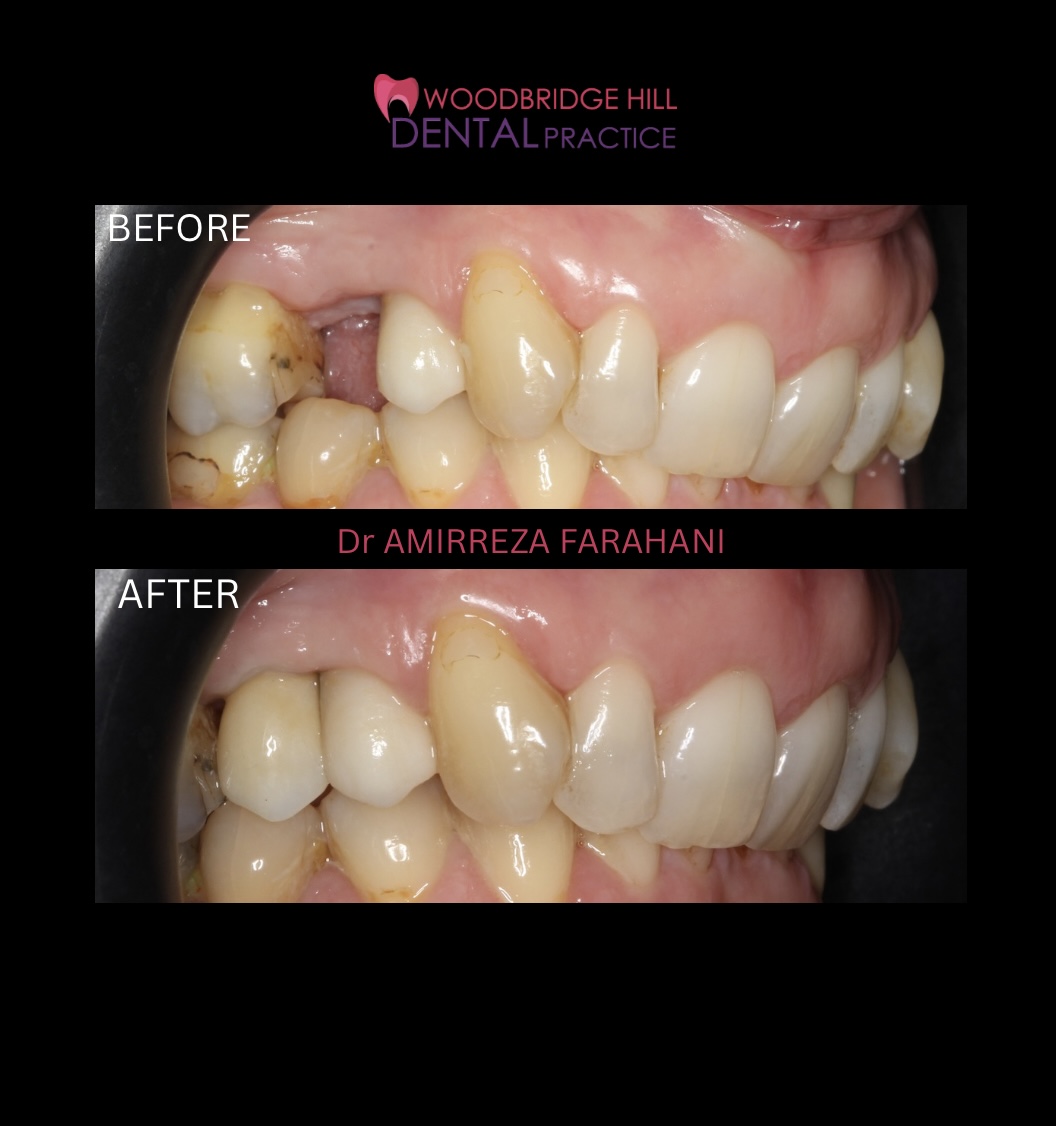 Before and after dental treatment case at Woodbridge Hill Dental Practice