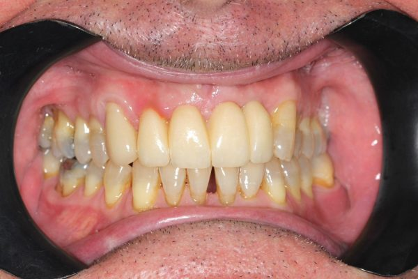 Upper front teeth restored with an implant bridge in Guildford