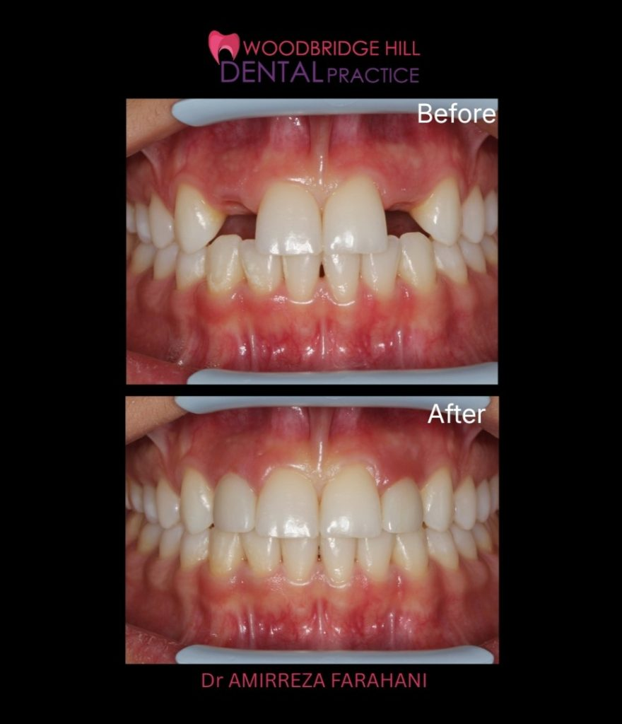 Dental implant result — front teeth before and after