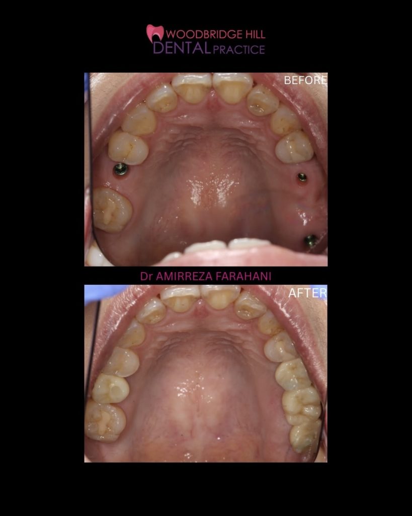 Dental implant before and after result, Guildford patient case 18