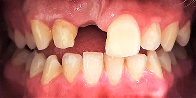 Missing front tooth before dental implant treatment in Guildford